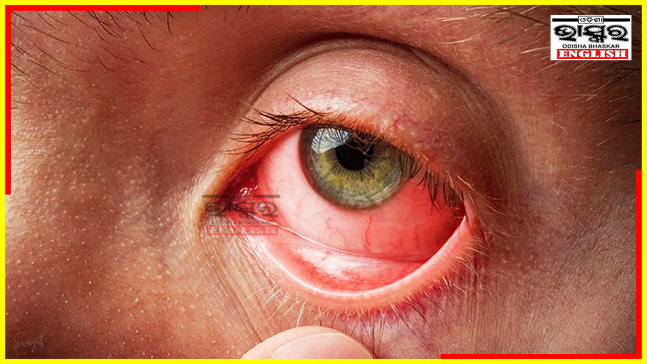 20% Increase in Conjunctivitis Cases Reported in Odisha, Health Department Cautions Public