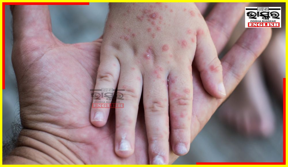 2 Rubella, 1 Measles Cases Detected in Nabarangpur Dist