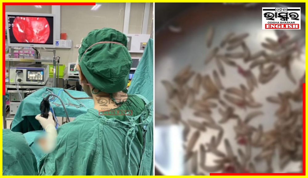 Over 100 Maggots Found Living in Nose of Woman in Thailand Over 100 maggots living in the nostrils of a 59-year-old woman were taken out by a medical team in Thailand. The woman was suffering stuffy nose, facial pain and later on also developed a nosebleed. At the Nakornping Hospital in Chiang Mai, Thailand, endoscopic examination revealed that hundreds of maggots were living inside her nostrils, the Mirror reported. After the removal of the maggots, the woman's condition reportedly improved dramatically. According to medical experts, if untreated, the larvae could have migrated to nearby organs like the eyes or brain, leading to serious complications or even death. In a post on Facebook, the Nakornping Hospital wrote, "Stuffed nose and nosebleeds for 1 week, thought it was because of PM 2.5 dust. Endoscopy found many worms in the nasal cavity. A 59-year-old woman had a stuffy nose and facial pain. She was being treated for sinusitis. Until I had a nosebleed and maggots crawling out of my nose, I decided to come to Nakornping Hospital." The caption further read, "Dr Pateemon Thanachaikhan, an otolaryngologist at Nakornping Hospital, examined the x-ray and found that the left zygomatic sinus had a white blemish. Endoscopy found more than 100 worms in both nasal cavities, so the worms were removed with forceps. The patient is now safe."